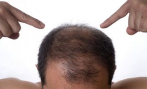 stopping hair loss naturally