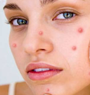 Pimples on Face, Pimple Cure, Homeopathic Remedy for Pimples | Hariomji.com